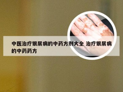 中医治疗银屑病的中药方剂大全 治疗银屑病的中药药方