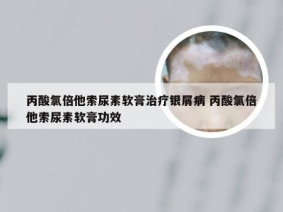 丙酸氯倍他索尿素软膏治疗银屑病 丙酸氯倍他索尿素软膏功效