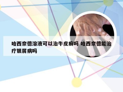 哈西奈德溶液可以治牛皮癣吗 哈西奈德能治疗银屑病吗