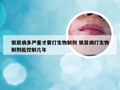 银屑病多严重才要打生物制剂 银屑病打生物制剂能控制几年