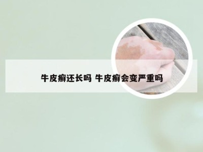 牛皮癣还长吗 牛皮癣会变严重吗