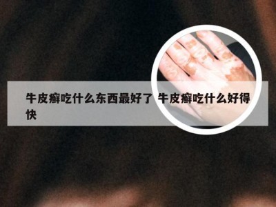 牛皮癣吃什么东西最好了 牛皮癣吃什么好得快