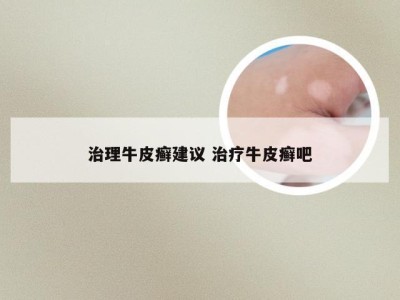 治理牛皮癣建议 治疗牛皮癣吧