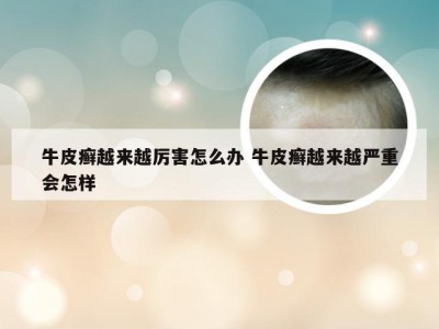 牛皮癣越来越厉害怎么办 牛皮癣越来越严重会怎样
