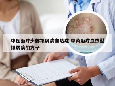 中医治疗头部银屑病血热症 中药治疗血热型银屑病的方子