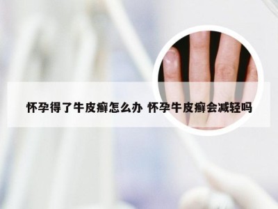 怀孕得了牛皮癣怎么办 怀孕牛皮癣会减轻吗