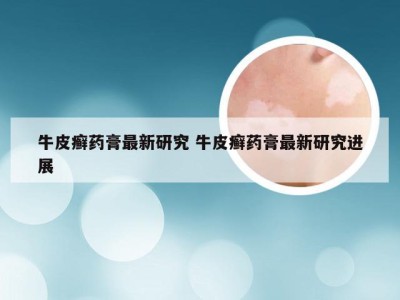 牛皮癣药膏最新研究 牛皮癣药膏最新研究进展