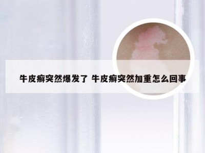 牛皮癣突然爆发了 牛皮癣突然加重怎么回事