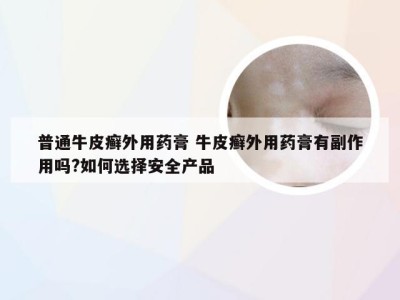 普通牛皮癣外用药膏 牛皮癣外用药膏有副作用吗?如何选择安全产品