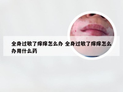 全身过敏了痒痒怎么办 全身过敏了痒痒怎么办用什么药