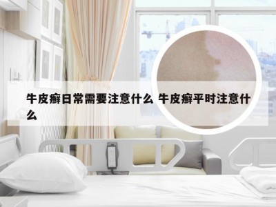 牛皮癣日常需要注意什么 牛皮癣平时注意什么