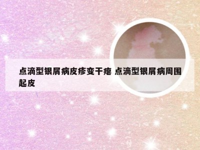 点滴型银屑病皮疹变干瘪 点滴型银屑病周围起皮