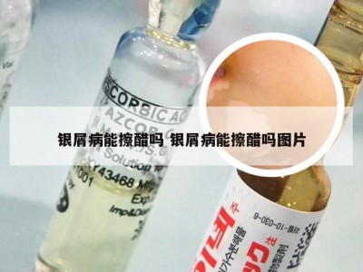银屑病能擦醋吗 银屑病能擦醋吗图片