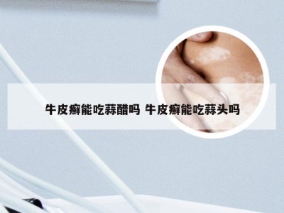 牛皮癣能吃蒜醋吗 牛皮癣能吃蒜头吗