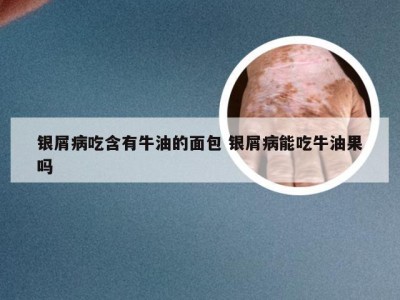 银屑病吃含有牛油的面包 银屑病能吃牛油果吗