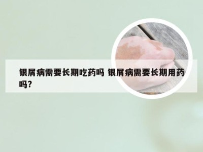 银屑病需要长期吃药吗 银屑病需要长期用药吗?