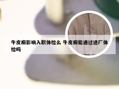 牛皮癣影响入职体检么 牛皮癣能通过进厂体检吗
