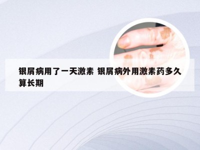 银屑病用了一天激素 银屑病外用激素药多久算长期