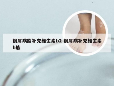 银屑病能补充维生素b2 银屑病补充维生素b族