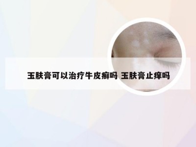 玉肤膏可以治疗牛皮癣吗 玉肤膏止痒吗
