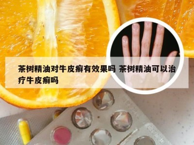 茶树精油对牛皮癣有效果吗 茶树精油可以治疗牛皮癣吗