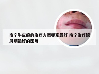 南宁牛皮癣的治疗方案哪家最好 南宁治疗银屑病最好的医院