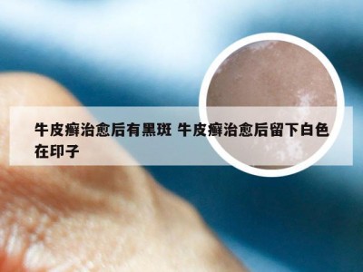 牛皮癣治愈后有黑斑 牛皮癣治愈后留下白色在印子