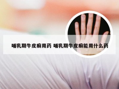 哺乳期牛皮癣用药 哺乳期牛皮癣能用什么药
