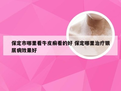 保定市哪里看牛皮癣看的好 保定哪里治疗银屑病效果好