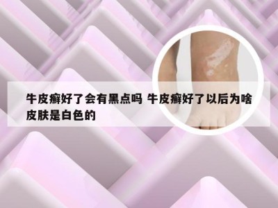 牛皮癣好了会有黑点吗 牛皮癣好了以后为啥皮肤是白色的