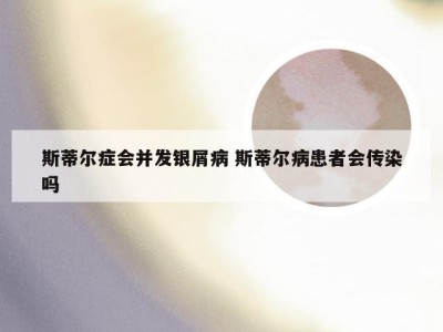 斯蒂尔症会并发银屑病 斯蒂尔病患者会传染吗