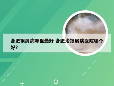 合肥银屑病哪里最好 合肥治银屑病医院哪个好?