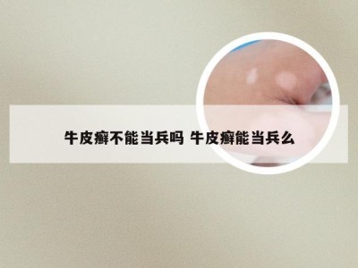 牛皮癣不能当兵吗 牛皮癣能当兵么