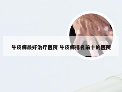牛皮癣最好治疗医院 牛皮癣排名前十的医院