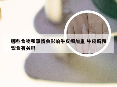 哪些食物和事情会影响牛皮癣加重 牛皮癣和饮食有关吗