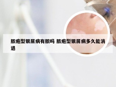 脓疱型银屑病有脓吗 脓疱型银屑病多久能消退
