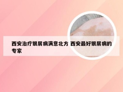 西安治疗银屑病满意北方 西安最好银屑病的专家