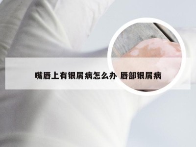 嘴唇上有银屑病怎么办 唇部银屑病