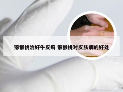 猕猴桃治好牛皮癣 猕猴桃对皮肤病的好处