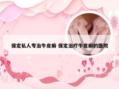 保定私人专治牛皮癣 保定治疗牛皮癣的医院