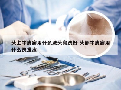 头上牛皮癣用什么洗头膏洗好 头部牛皮癣用什么洗发水