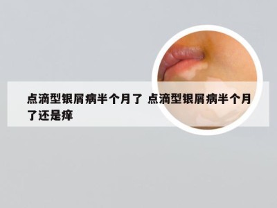 点滴型银屑病半个月了 点滴型银屑病半个月了还是痒