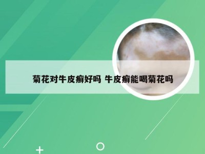 菊花对牛皮癣好吗 牛皮癣能喝菊花吗