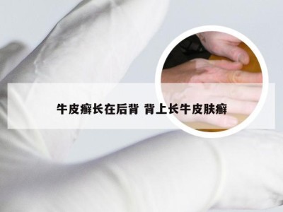 牛皮癣长在后背 背上长牛皮肤癣