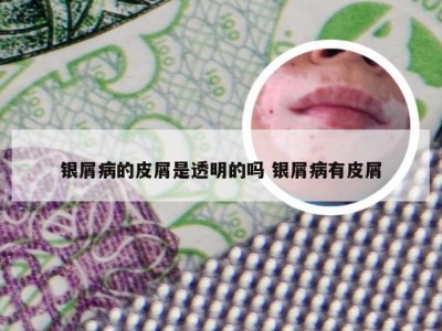 银屑病的皮屑是透明的吗 银屑病有皮屑