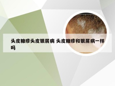 头皮糠疹头皮银屑病 头皮糠疹和银屑病一样吗