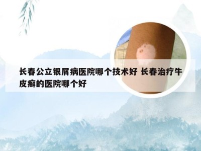 长春公立银屑病医院哪个技术好 长春治疗牛皮癣的医院哪个好