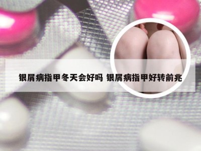 银屑病指甲冬天会好吗 银屑病指甲好转前兆