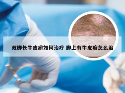 双脚长牛皮癣如何治疗 脚上有牛皮癣怎么治