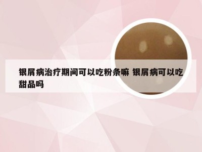 银屑病治疗期间可以吃粉条嘛 银屑病可以吃甜品吗